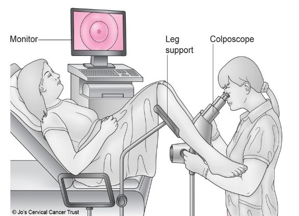  Diagram showing a colposcopy.